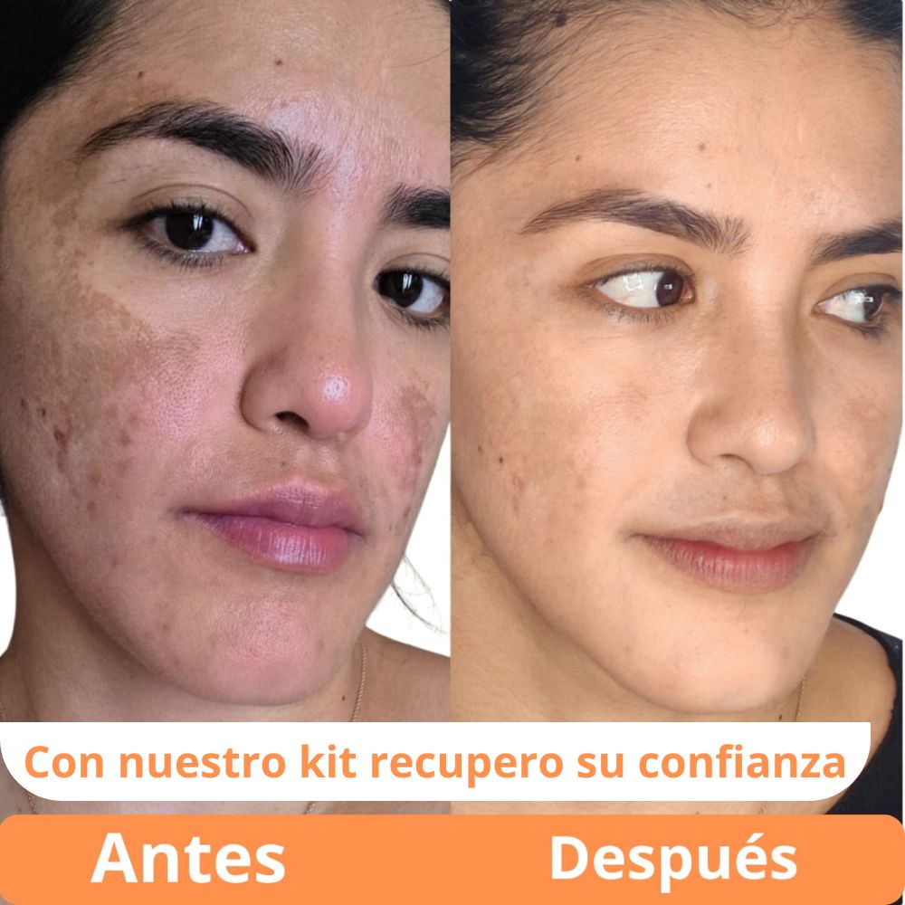 Kit BB Glow Fusión: Tónico Despigmentante, Colágeno y Ácido Hialurónico